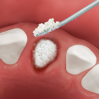 Kép 6/9 - Osteobiol TSV Gel 1 fecskendő kit + Gen-Os 0,5gr