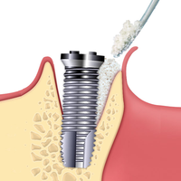 Kép 7/9 - Osteobiol TSV Gel 1 fecskendő kit + Gen-Os 0,5gr