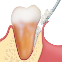 Kép 8/9 - Osteobiol TSV Gel 1 fecskendő kit + Gen-Os 0,5gr