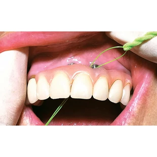 Implantátum gondozása és tisztítása