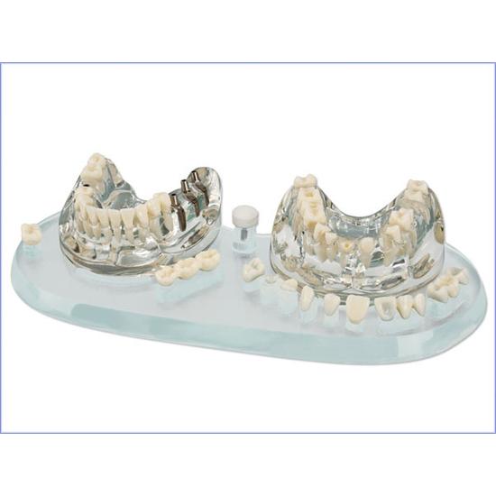 AKCIÓ - Oktató modell STUDY MODEL DEMO IMPLANT C+B