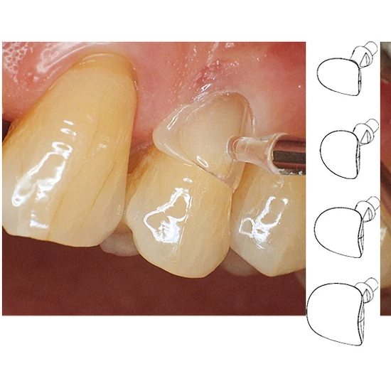 Cervical Matrices (60db),fognyaki matrica kis őrlőkhöz