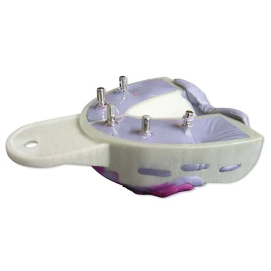 Miratray Implant felső OK S2 medium  6db