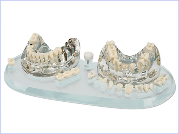 AKCIÓ - Oktató modell STUDY MODEL DEMO IMPLANT C+B
