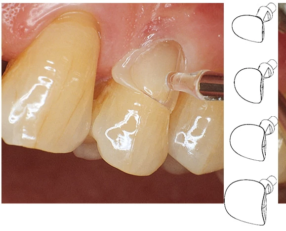 Cervical Matrices (60db),fognyaki matrica kis őrlőkhöz