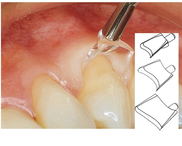 Gingival retractor (3x30),fogínyvisszahúzó sortiment